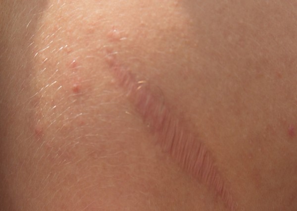 Summary 640x454 daniels scar